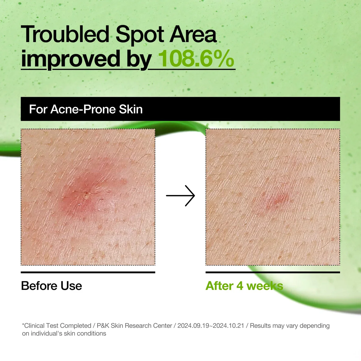 Azelaic Acid 10 Hyaluron Redness Soothing Serum - Image 9