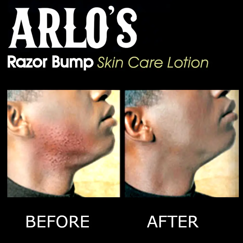 Razor Bump Skin Care Lotion - Image 2