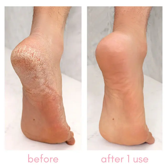 Heel-ing Callus Remover - Image 3