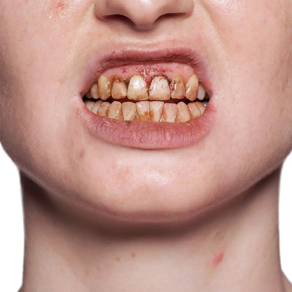 Tooth Enamel Red - Image 3