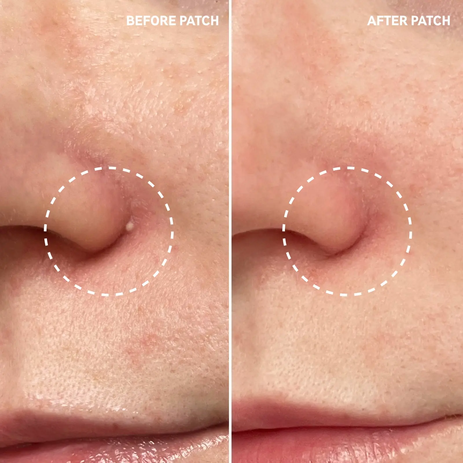Hydrocolloid Invisible Pimple Patches - Image 6